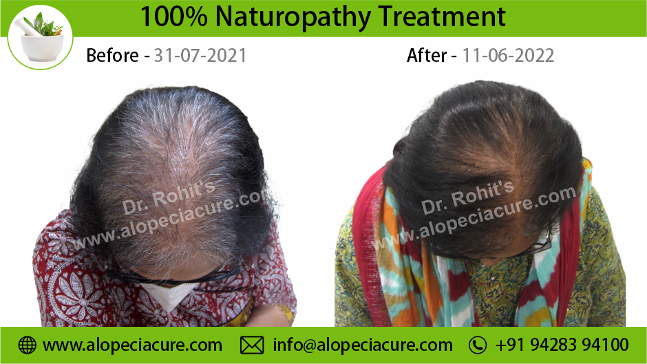 female hair loss treatment Alopecia treatment Center in Canada