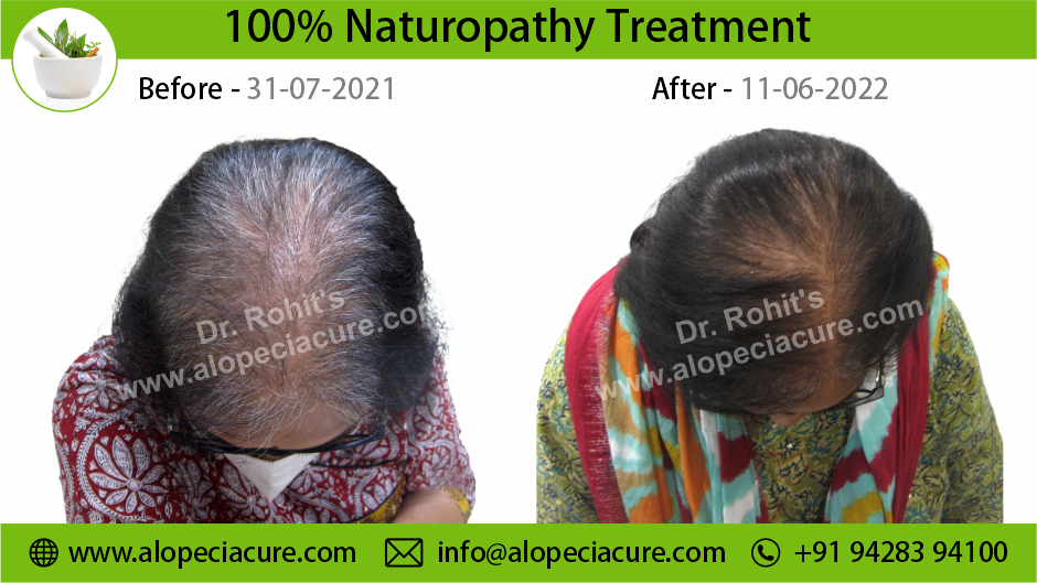 female hair loss treatment Pune