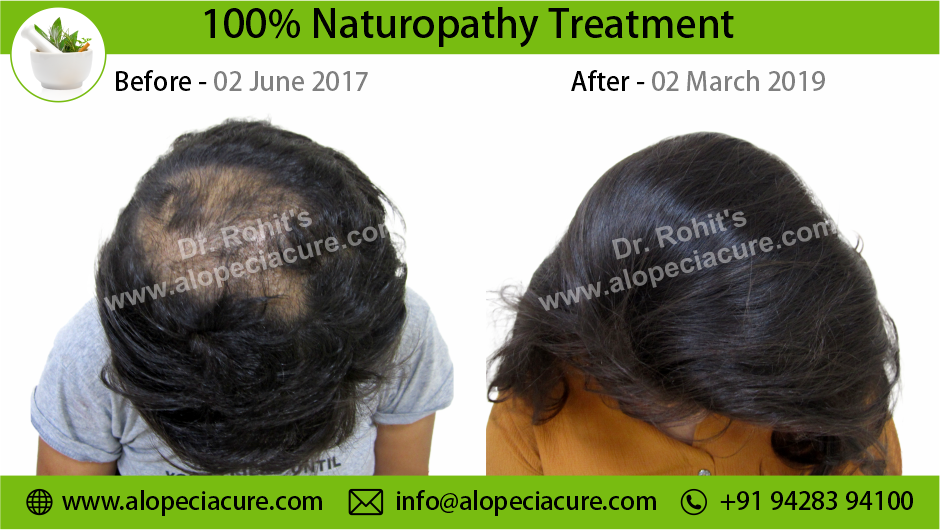 trichotillomania treatment Indore