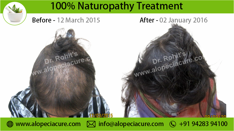 female hair loss treatment Raipur