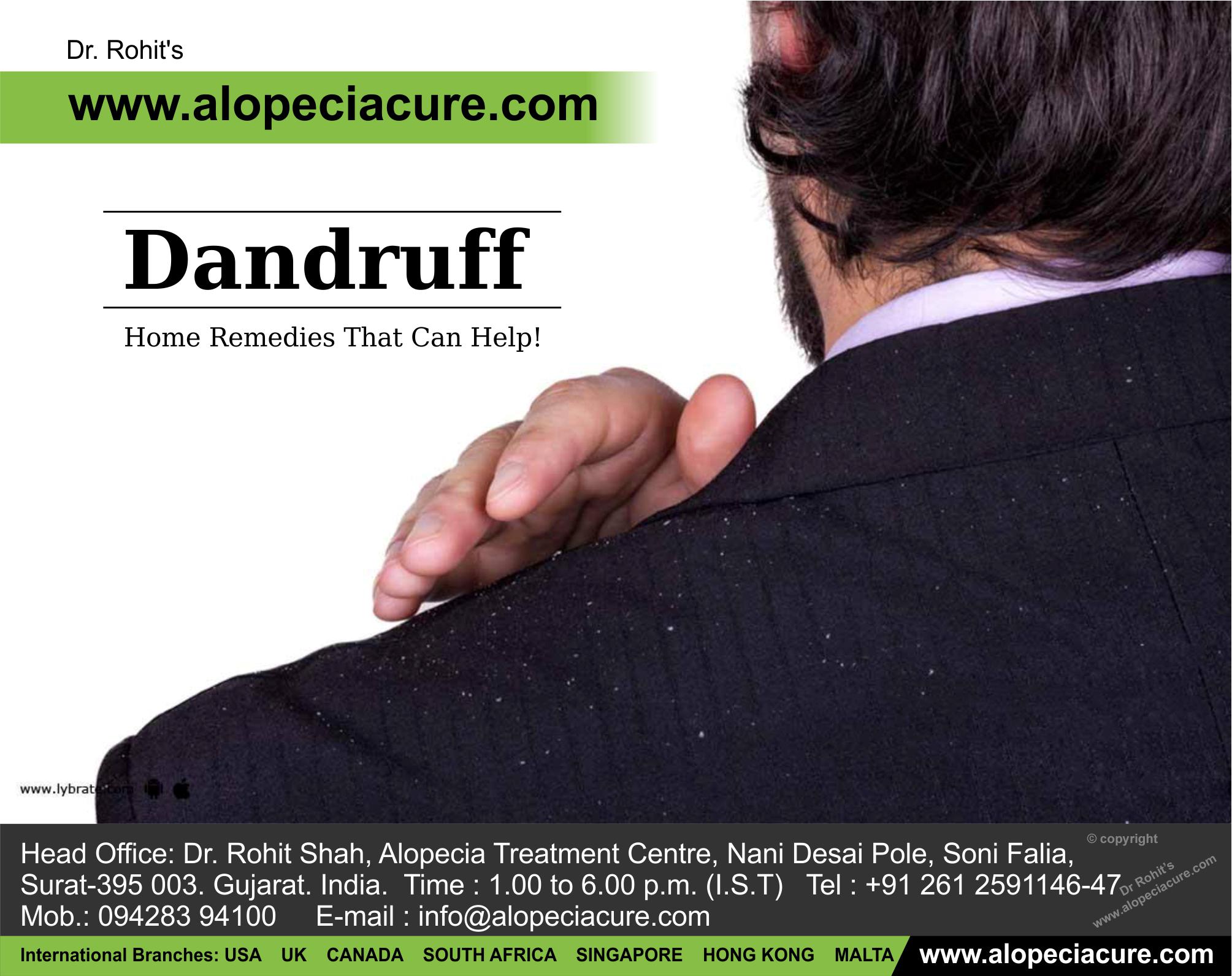 Dandruff - 5 Home Remedies That Can Help!
