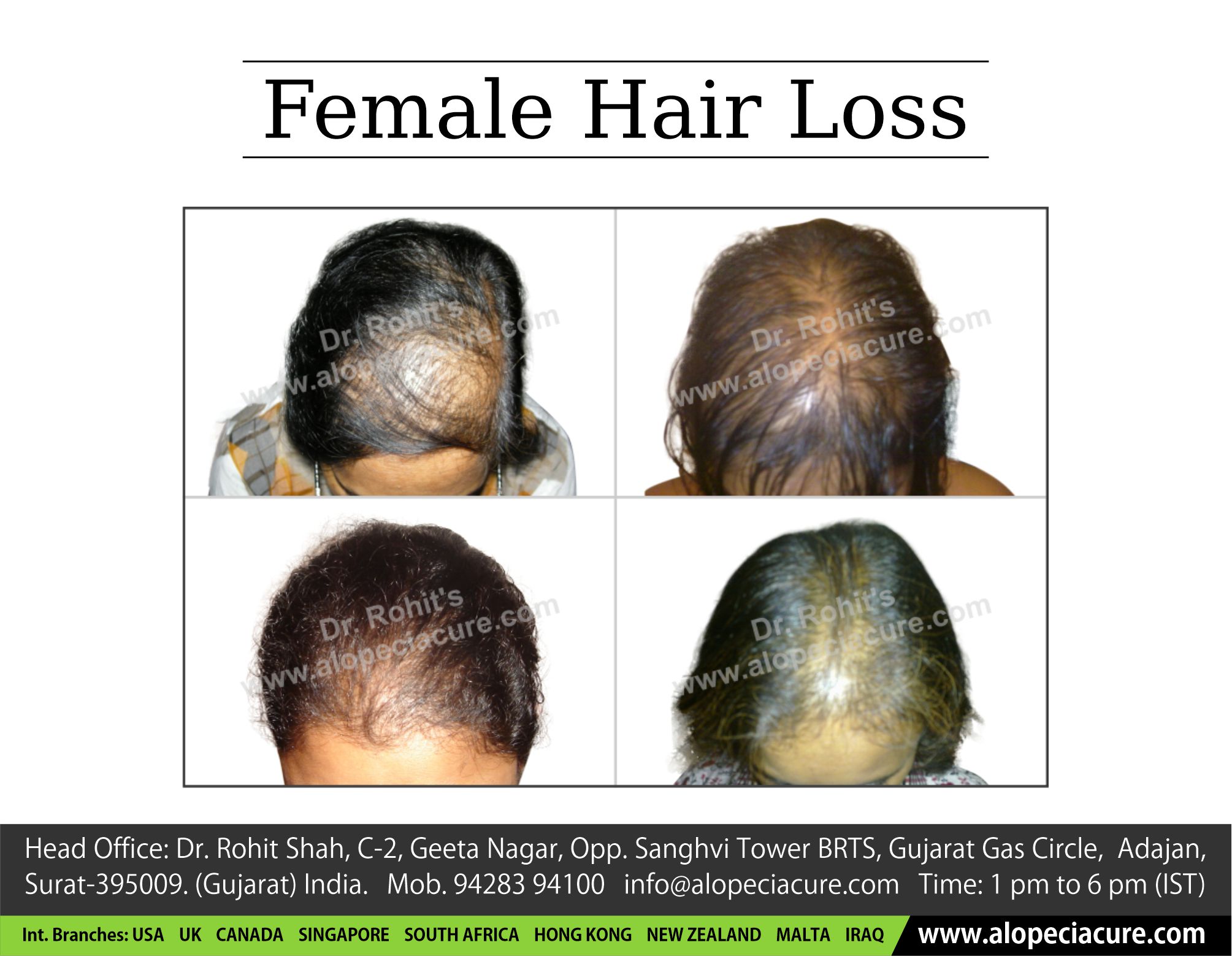 Female Pattern Baldness  Causes  Treatments