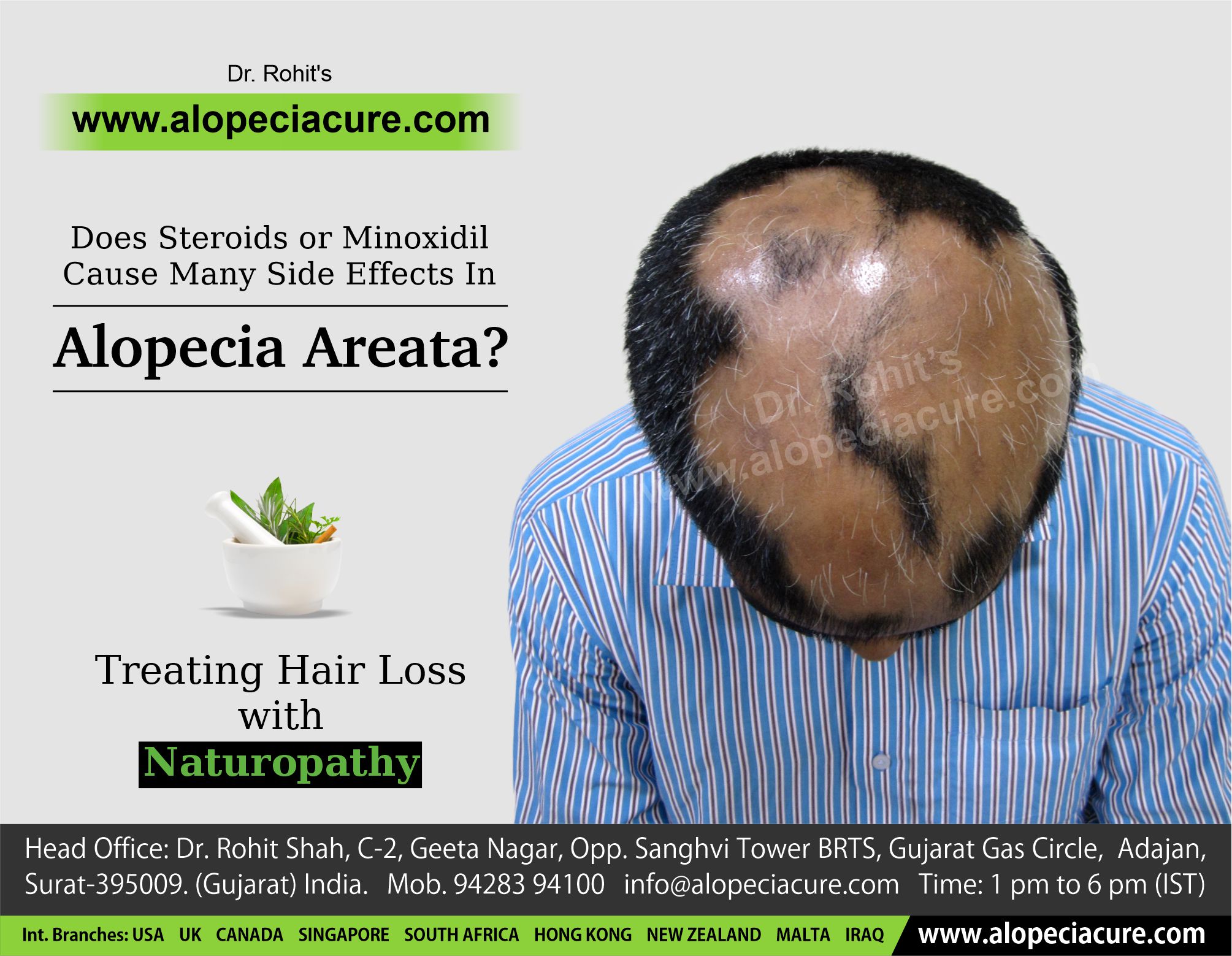 Does Steroids Or Minoxidil Cause Many Side Effects In Alopecia Areata?