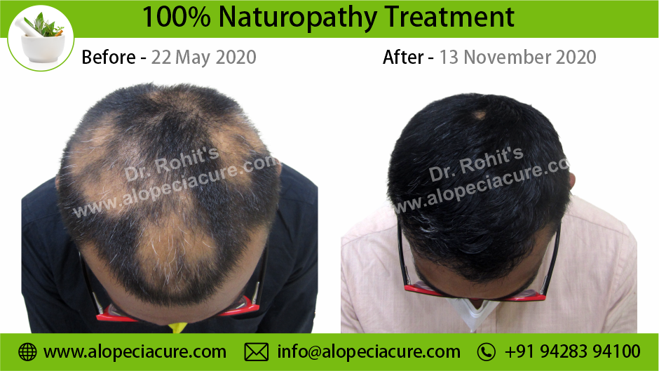 alopecia areata treatment