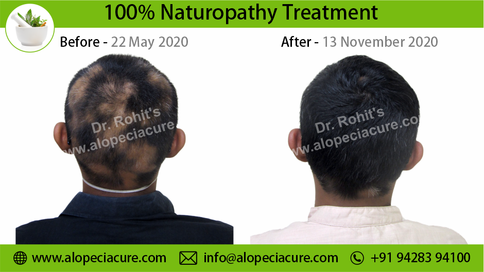 alopecia areata treatment