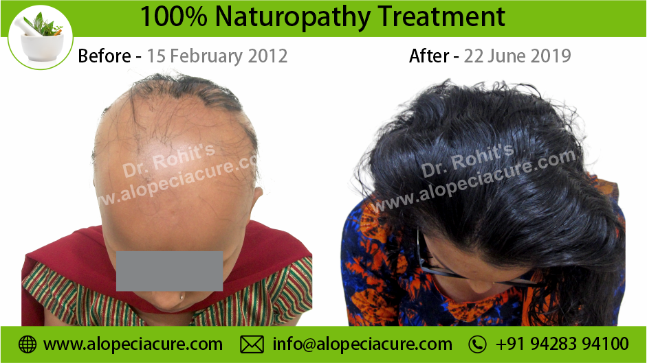 alopecia areata treatment