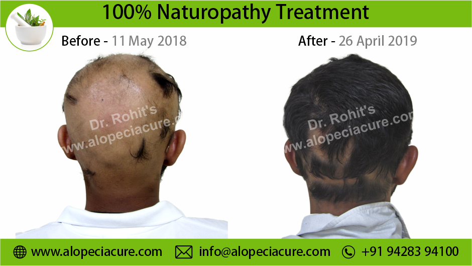 alopecia areata treatment