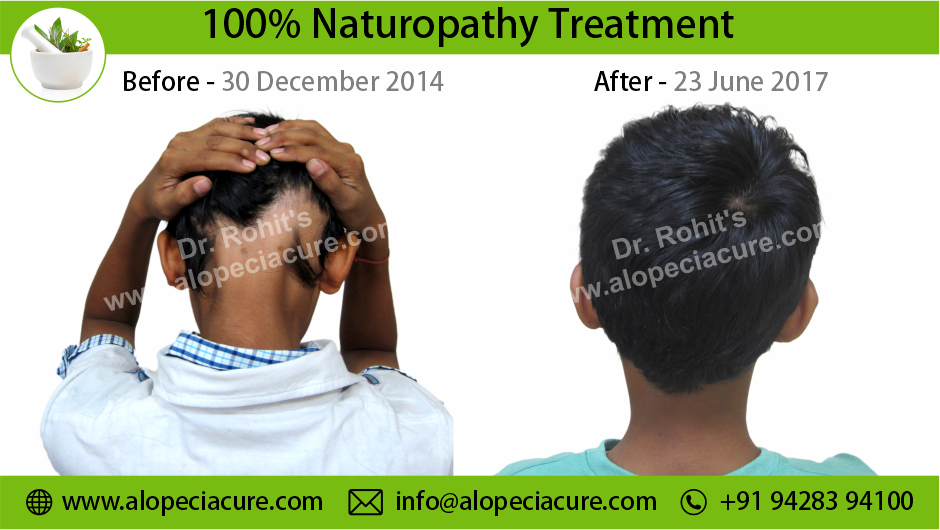 alopecia areata treatment