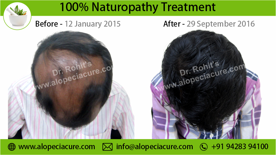 alopecia areata treatment