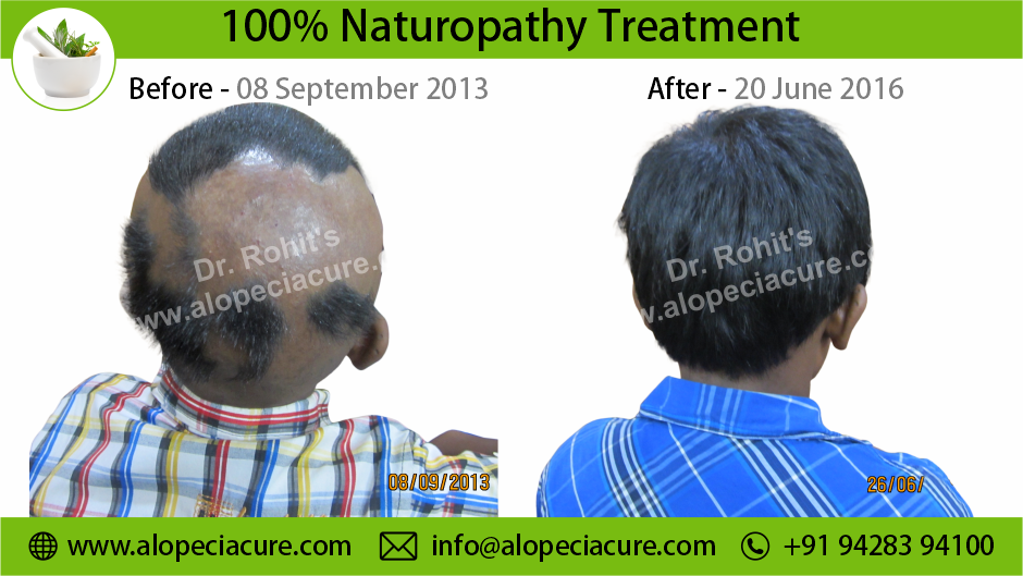 alopecia areata treatment