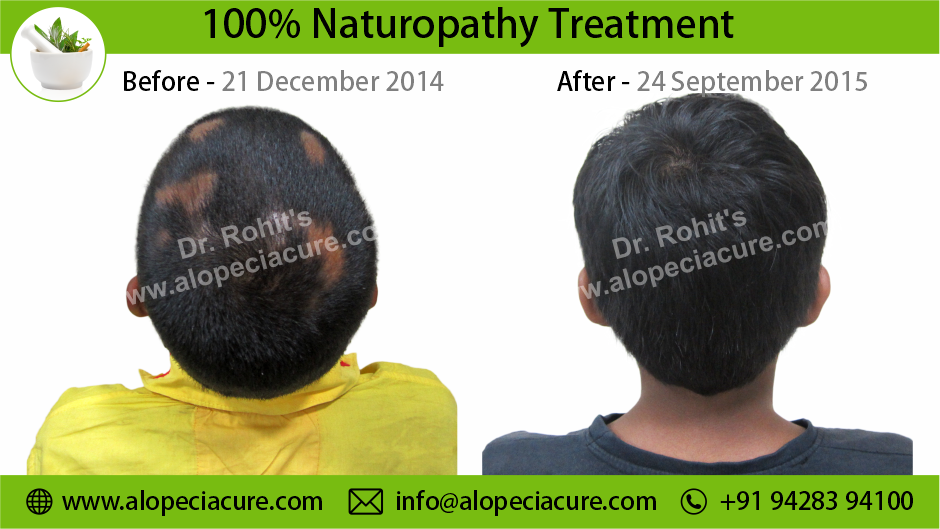 alopecia areata treatment