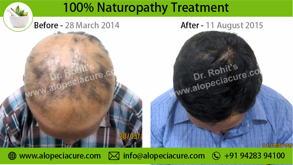 alopecia areata treatment