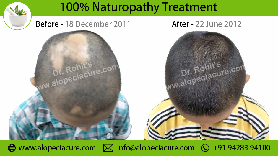 alopecia areata treatment