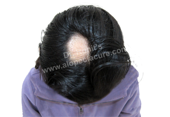 Alopecia Areata