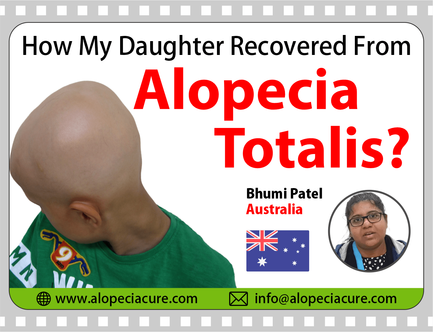 Australia patient review for Dr. Rohit's natural treatment for alopecia totalis