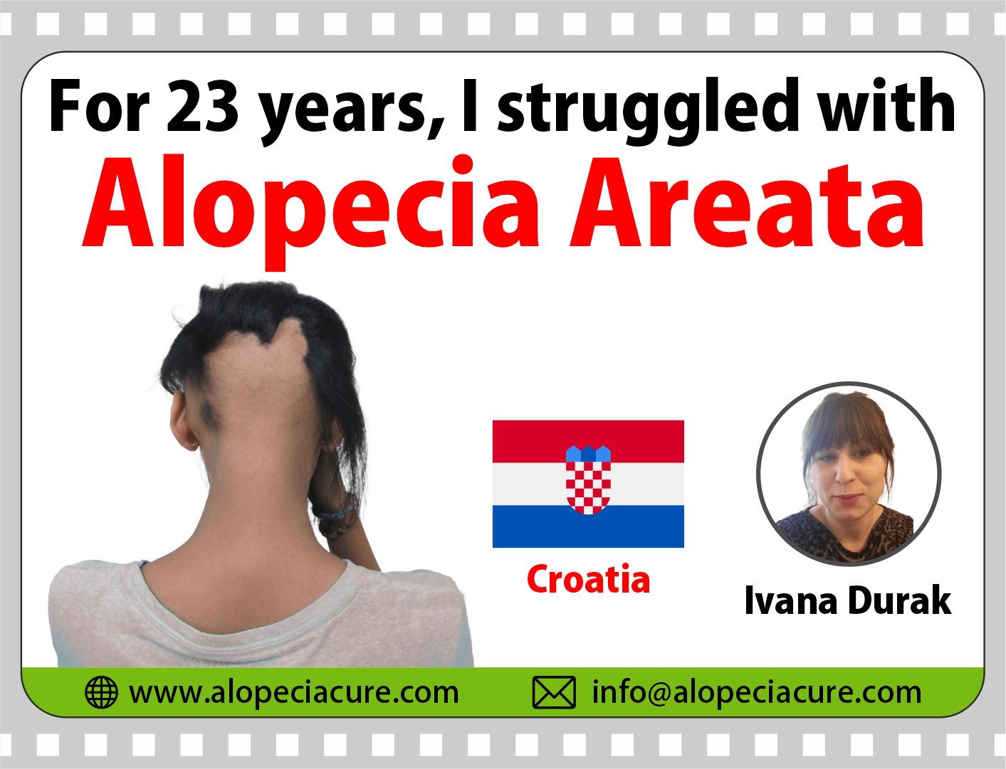 Croatia patient review for Dr. Rohit's natural treatment for alopecia totalis