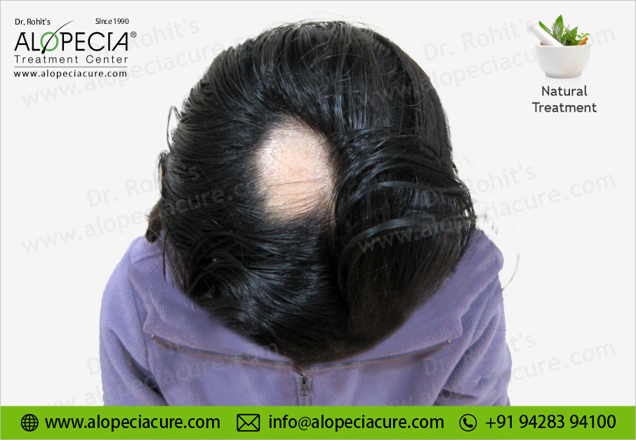 Alopecia areata