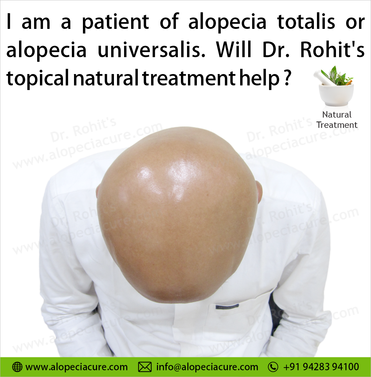 Alopecia totalis or alopecia universalis