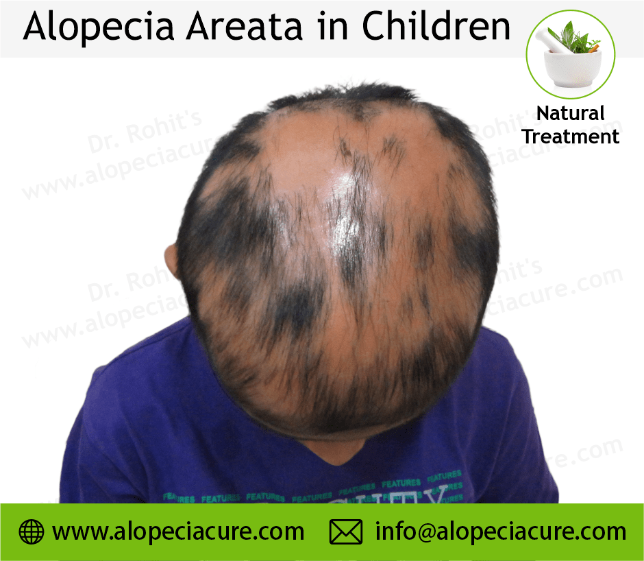 Child Alopecia Areata