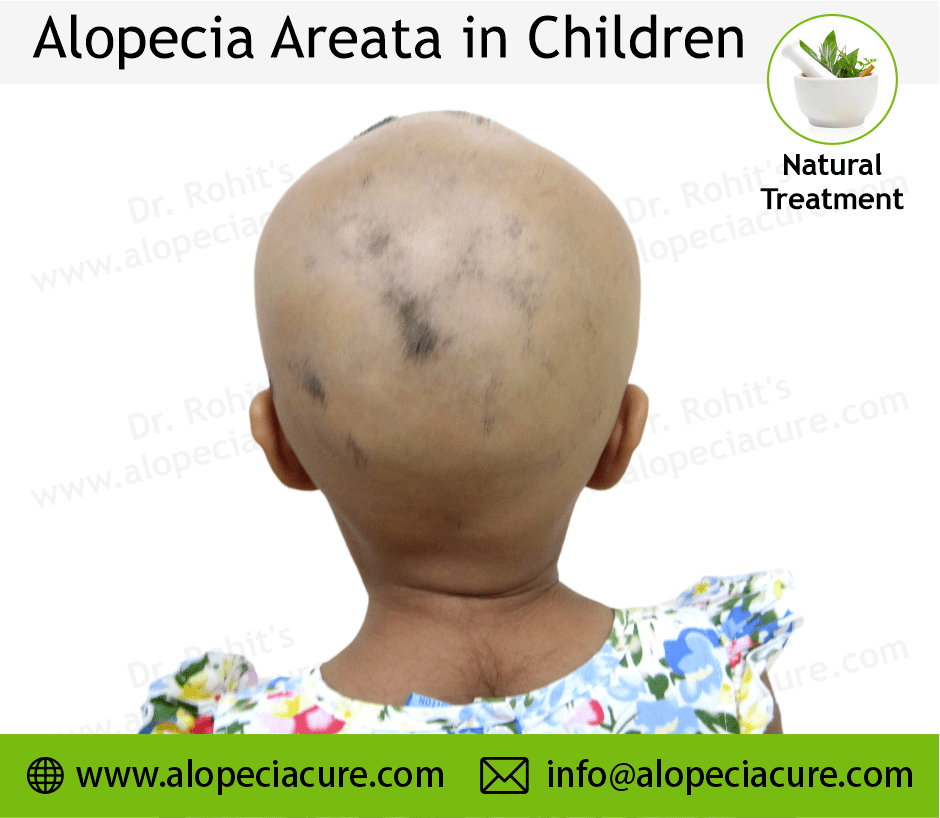 Child Alopecia Areata