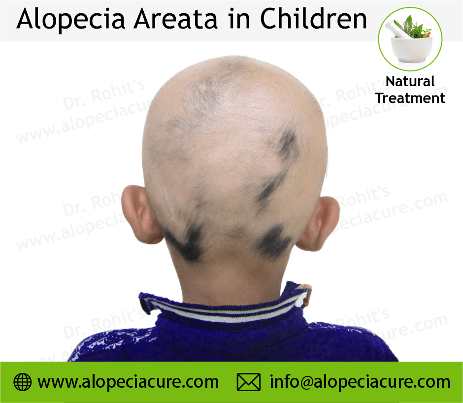 Child Alopecia Areata