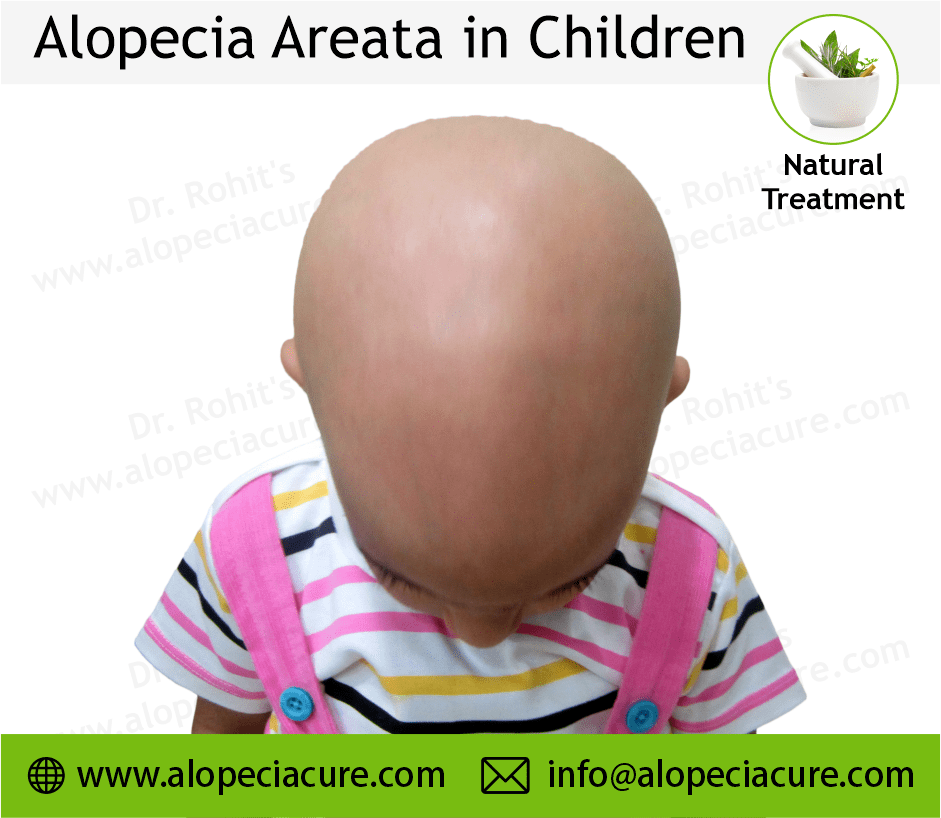 Child Alopecia Areata