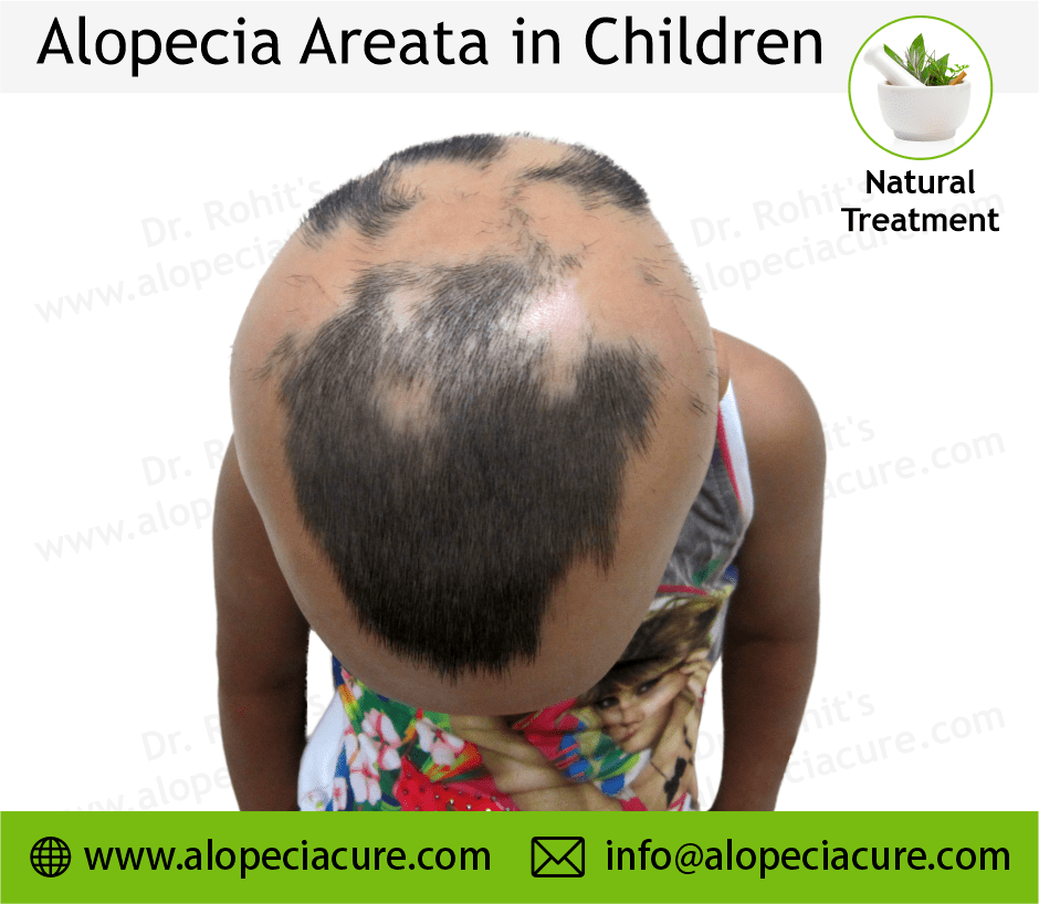 Child Alopecia Areata