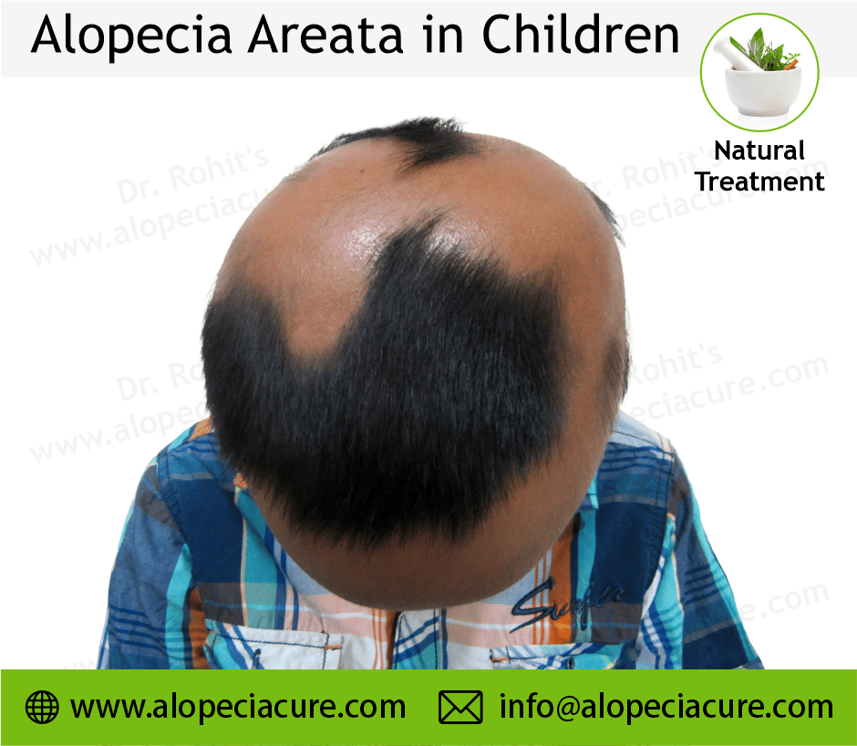 Child Alopecia Areata
