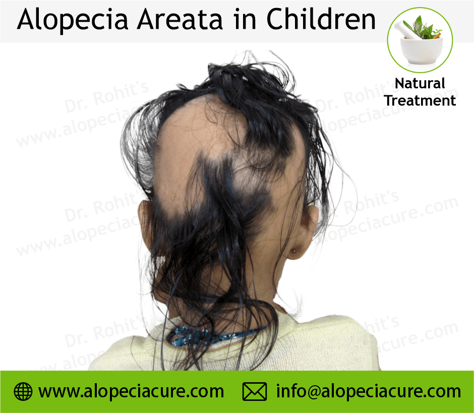 Child Alopecia Areata