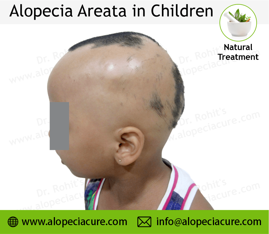 Child Alopecia Areata