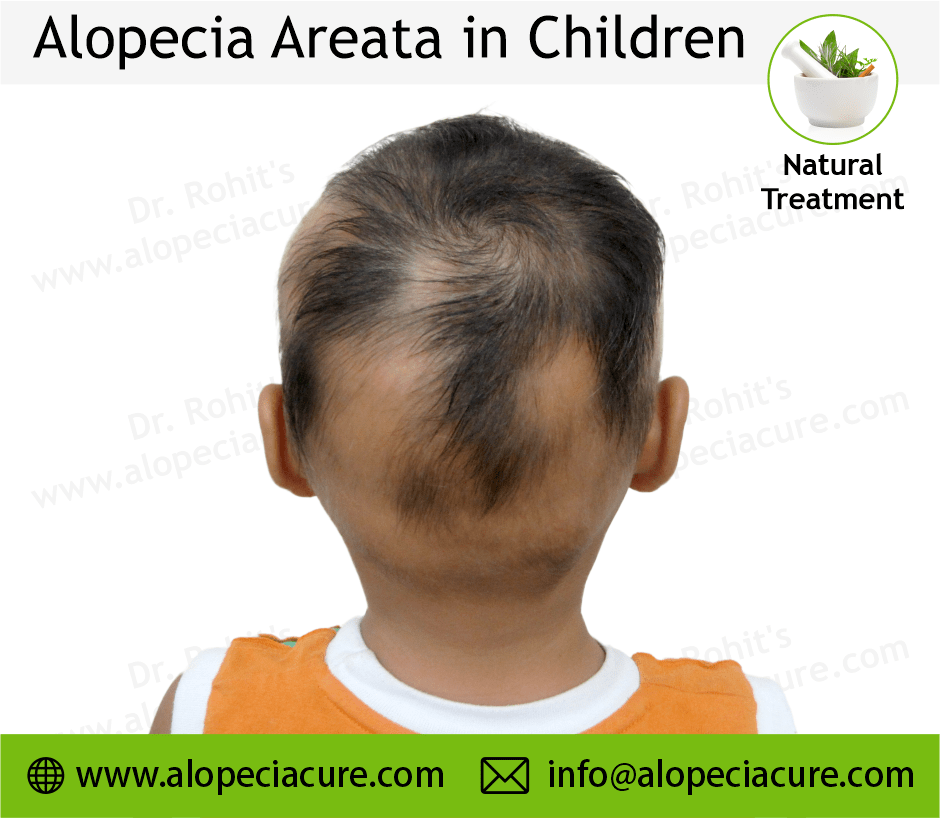 Child Alopecia Areata