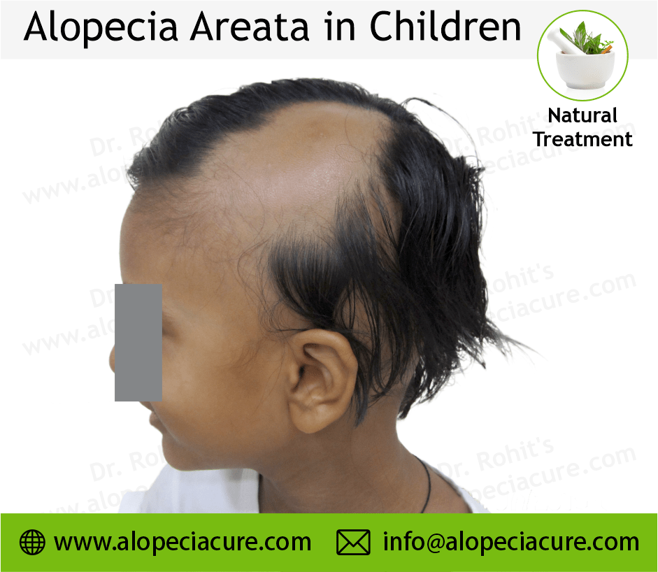 Child Alopecia Areata