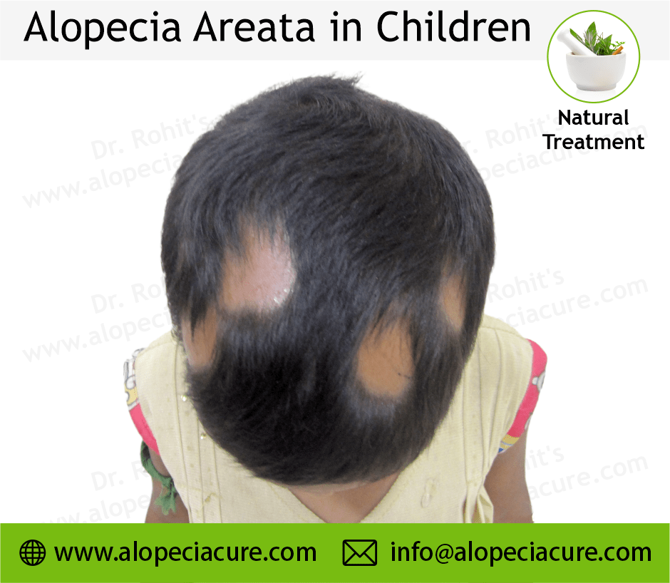 Child Alopecia Areata