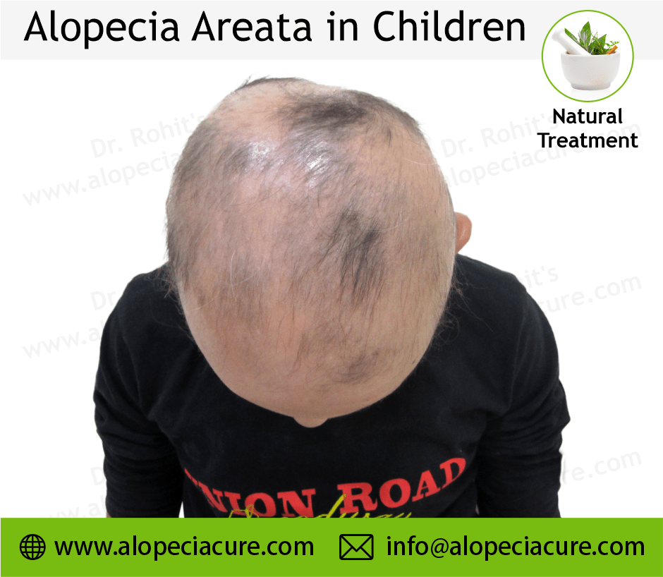 Child Alopecia Areata