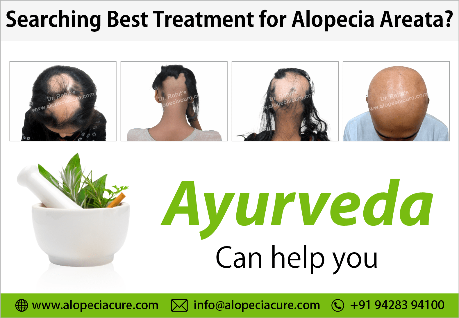 Dr. Rohit's Alopecia Treatment Center for alopecia areata