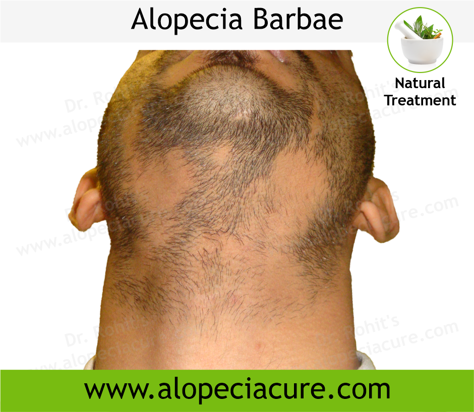 Alopecia Barbae