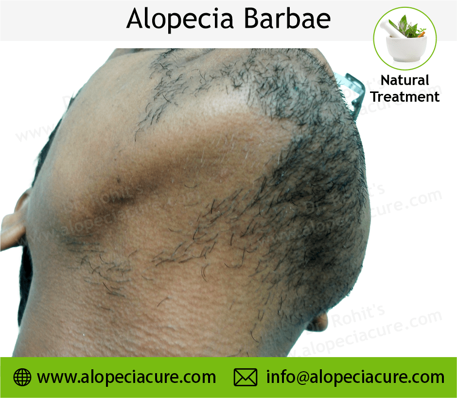 Alopecia Barbae