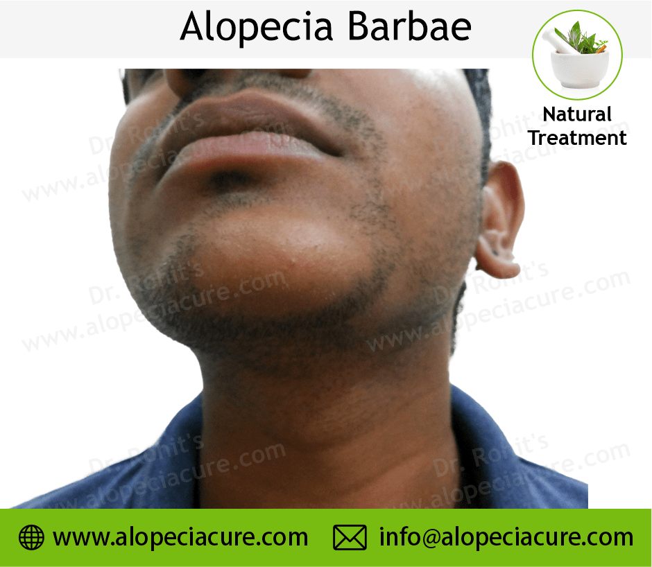 Alopecia Barbae