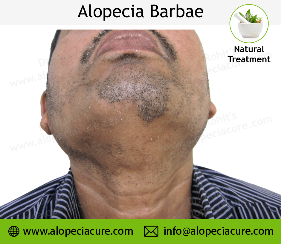 Alopecia Barbae