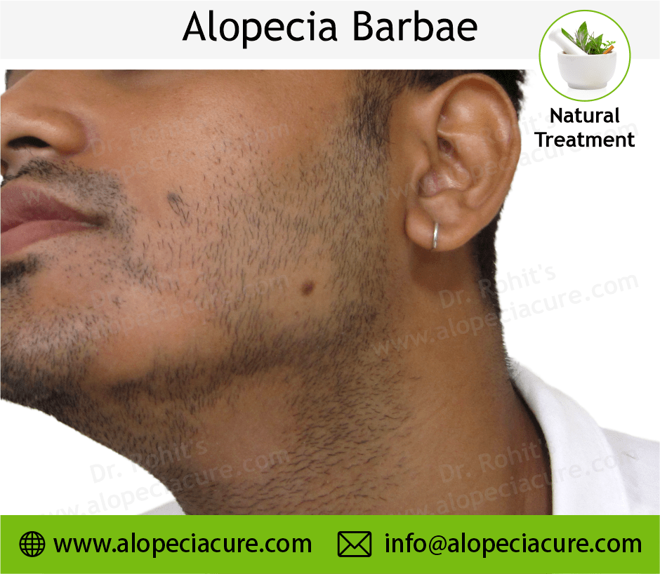 Alopecia Barbae