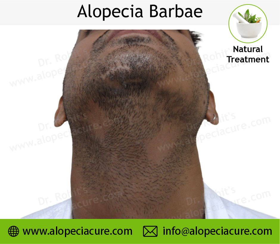 Alopecia Barbae