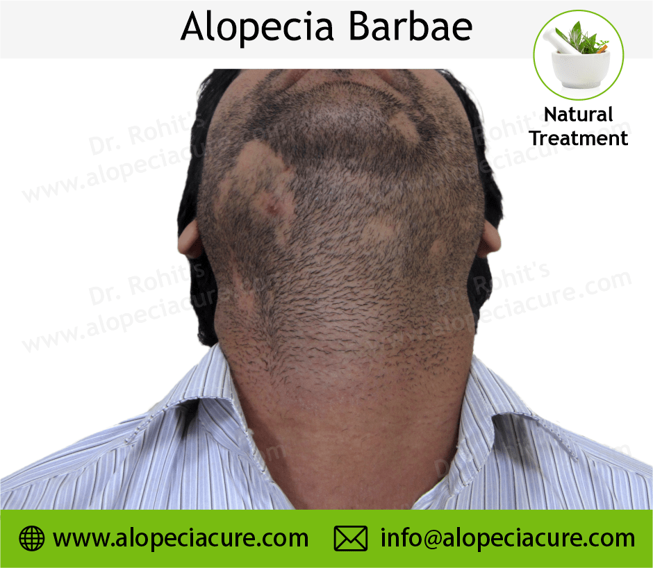 Alopecia Barbae