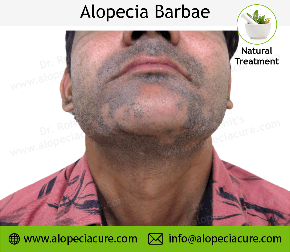 Alopecia Barbae