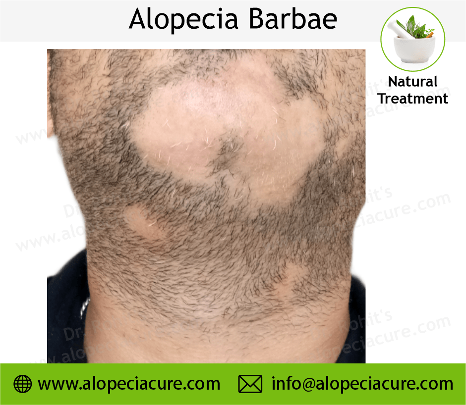 Alopecia Barbae