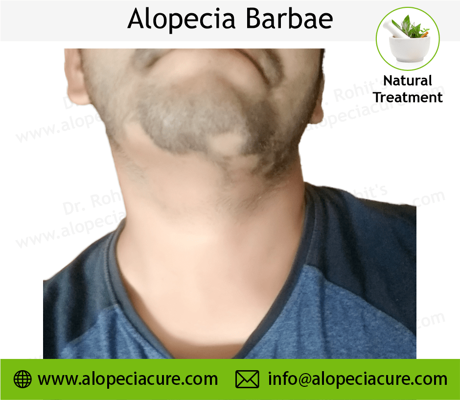 Alopecia Barbae