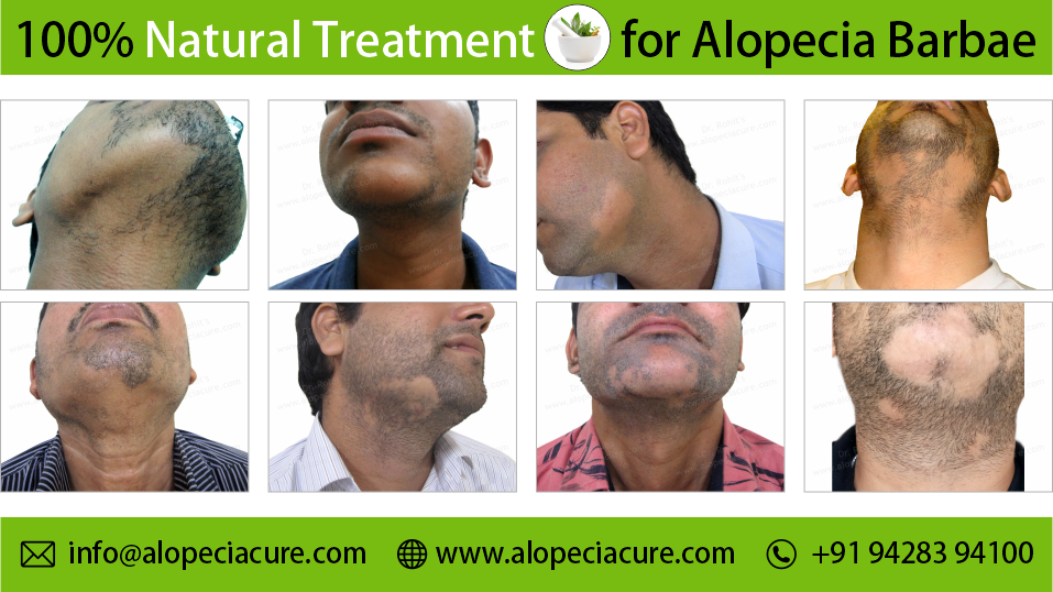 Alopecia on sale barbae treatment