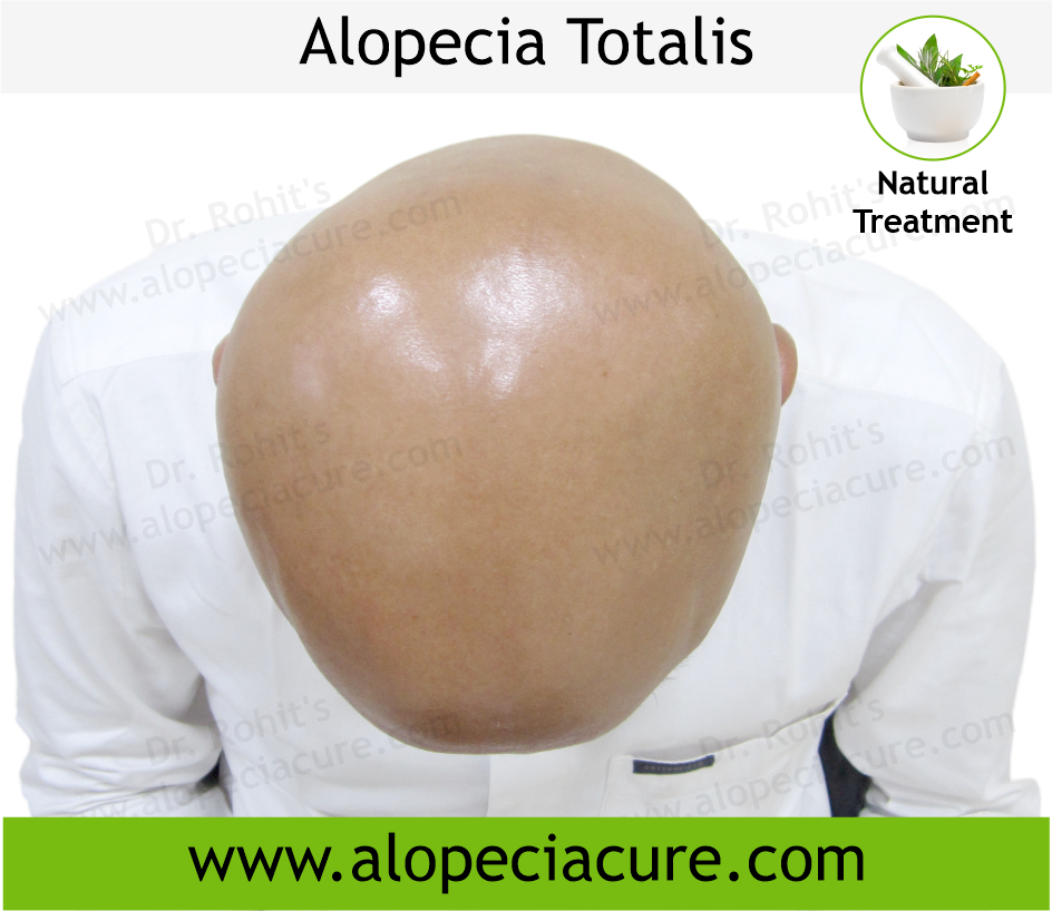 Alopecia Totalis