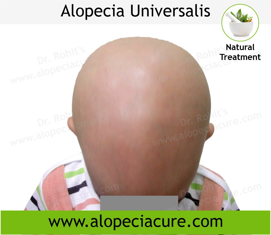 Alopecia Universalis