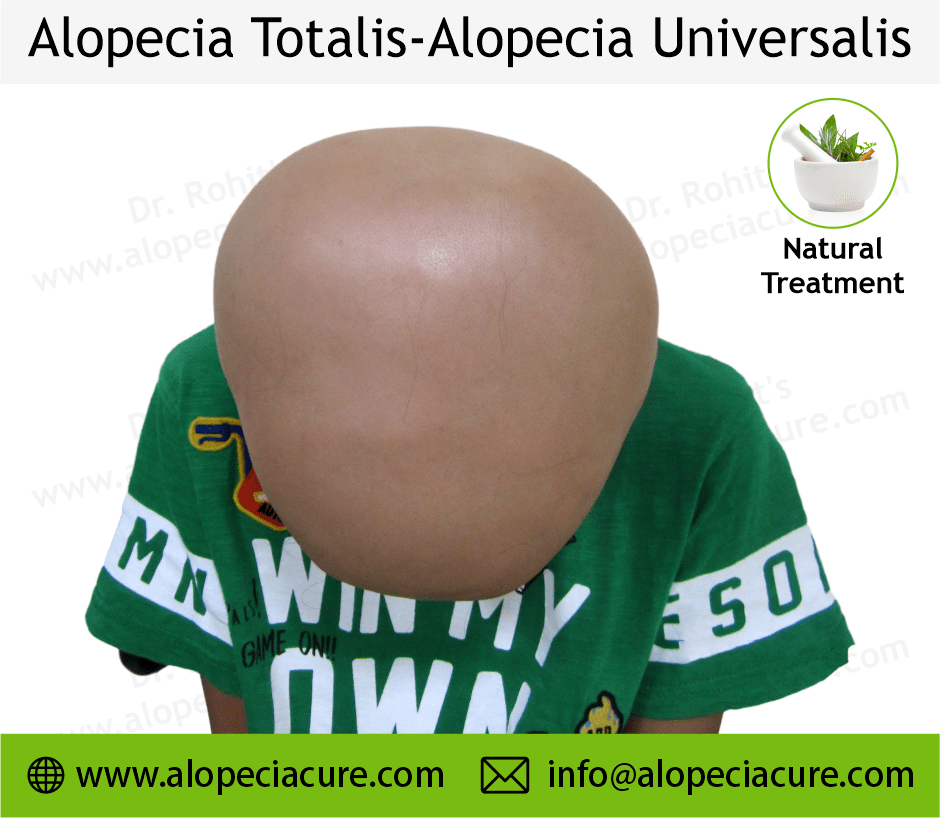 Alopecia totalis