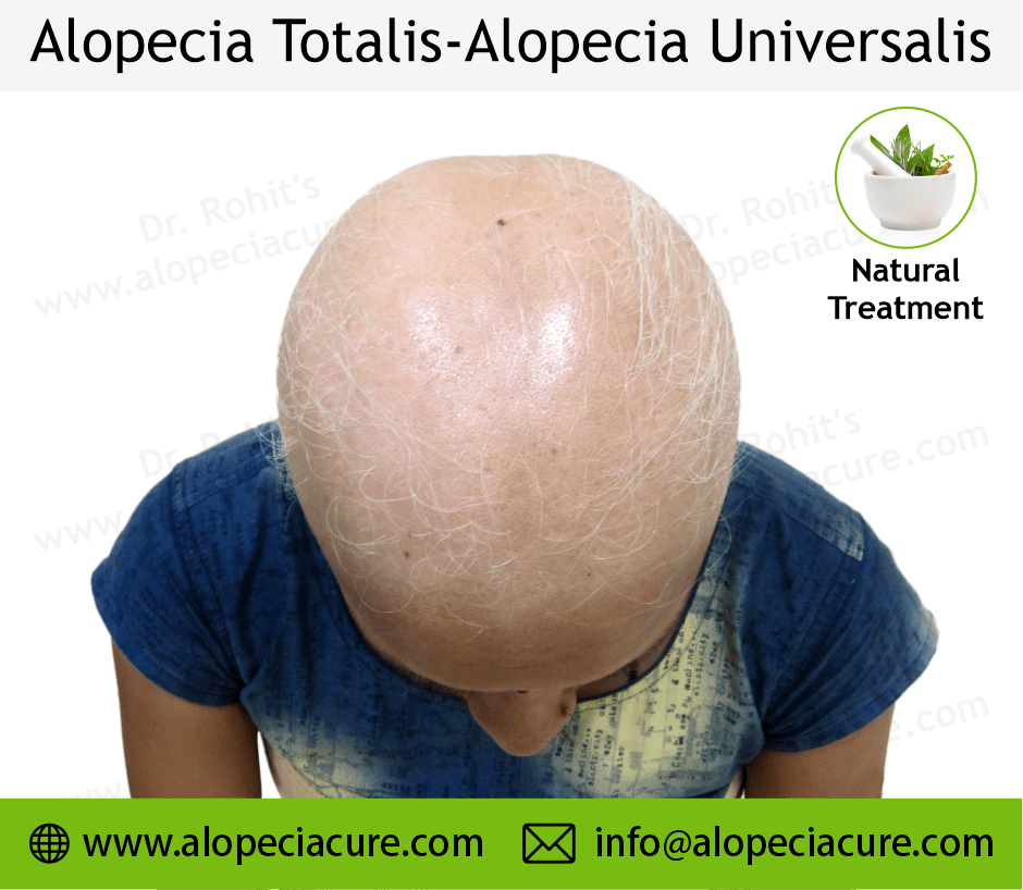 Alopecia Universalis